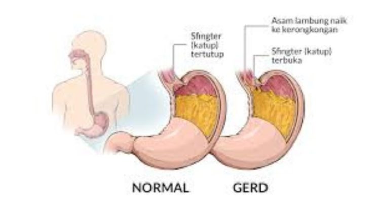 GERD, Ancaman Senyap di Balik Meja Kerja: Pahami dan Atasi Sebelum Terlambat